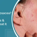 What Is Rosacea? Causes, Symptoms & How to Treat It