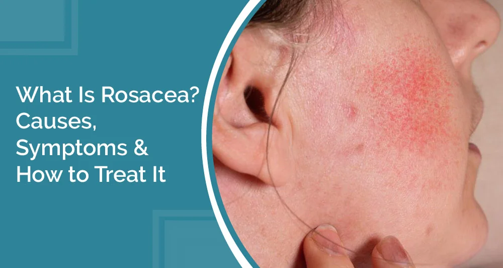 What Is Rosacea Causes Symptoms How to Treat It 01