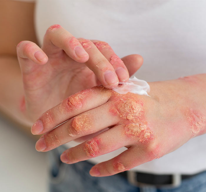 What is Psoriasis