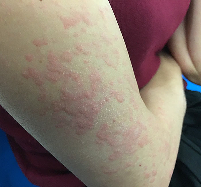 What is Urticaria Hives