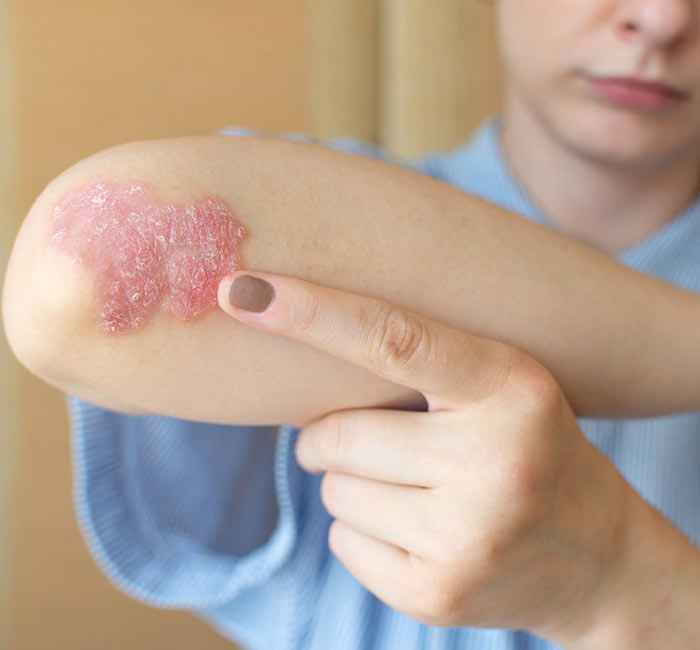 Why Choose Us For Psoriasis Treatment in Vile Parle