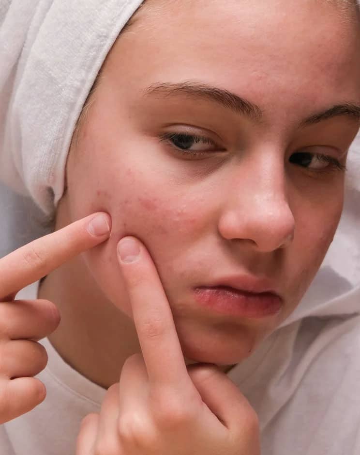 auro skin acne scar treatment in mumbai auro skin acne scar treatment in mumbai