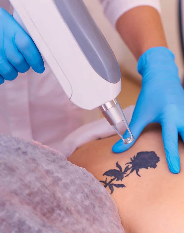 auro skin laser pigmentation treatment auro skin laser pigmentation treatment