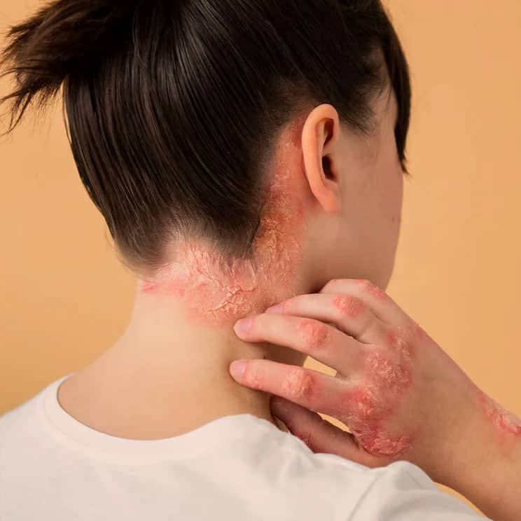 auro skin psoriasis treatment auro skin psoriasis treatment