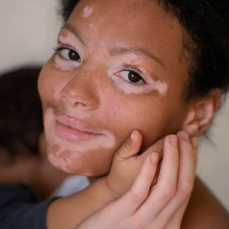 auro skin vitiligo treatment auro skin vitiligo treatment