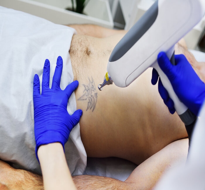tattoo removal treatment