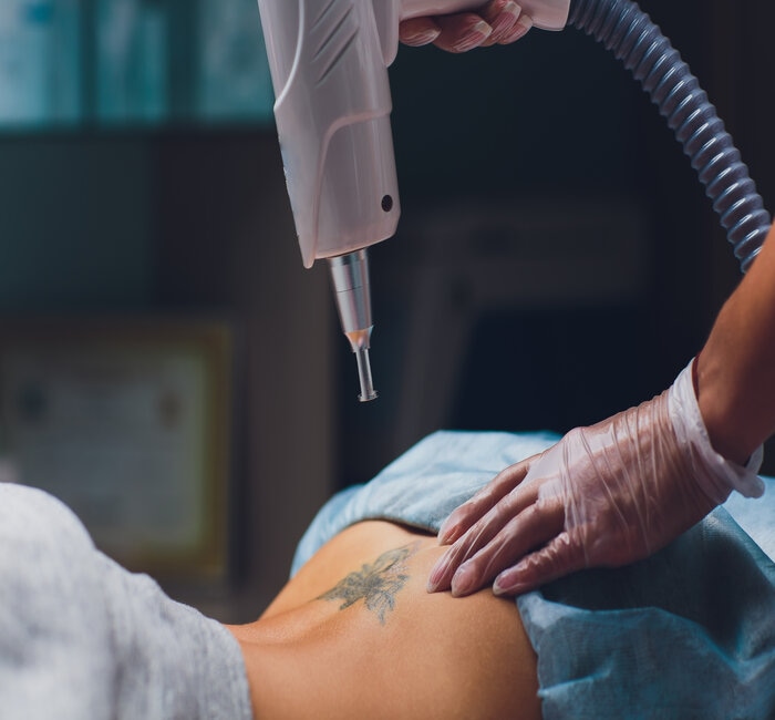 laser tattoo removal