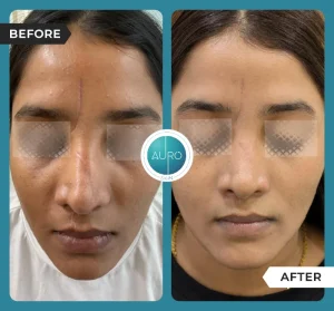 Dermapen vs. RF Microneedling: Key Differences 5 dermapen microneedling benefits