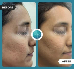 Dermapen vs. RF Microneedling: Key Differences 3 dermapen microneedling cost