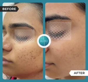 Dermapen vs. RF Microneedling: Key Differences 6 dermapen microneedling in Mumbai