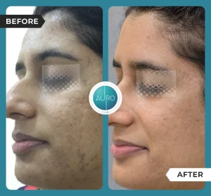 Dermapen vs. RF Microneedling: Key Differences 4 dermapen microneedling treatment