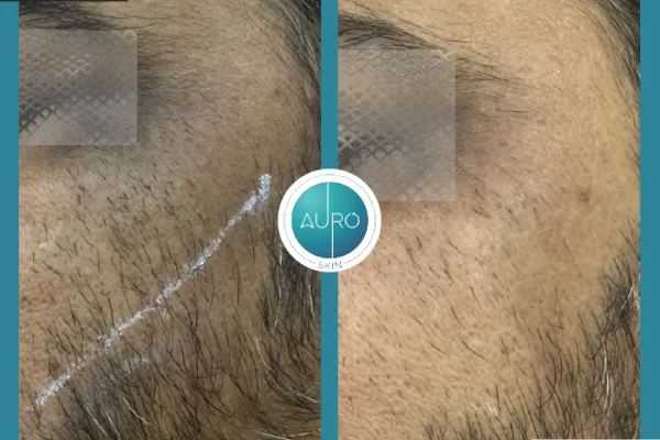 1. Laser hair removal rew16m84wm54dhkj0mtaoptzhp9swgjvowjh2bty8w