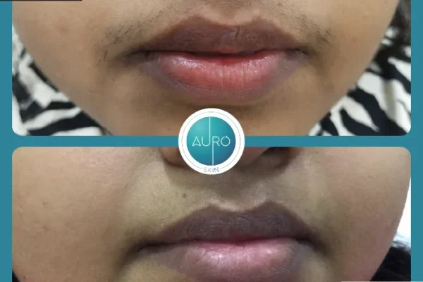 2. Laser hair reduction