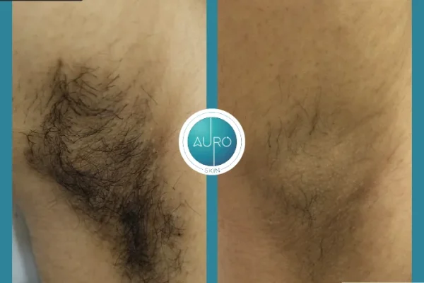 4. lhr treatment in Vile Parle