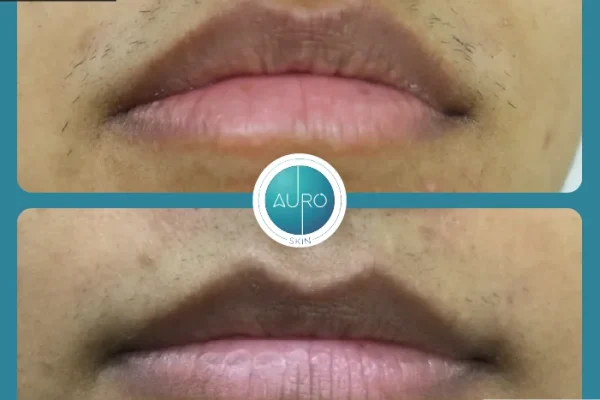 5. lhr treatment in Mumbai