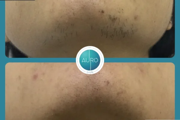 6. Laser hair reduction treatment in Mumbai rew175yqw4w55arutdcgn2unyskie3q8rm8o550om8