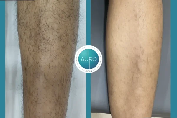 7. laser hair treatment