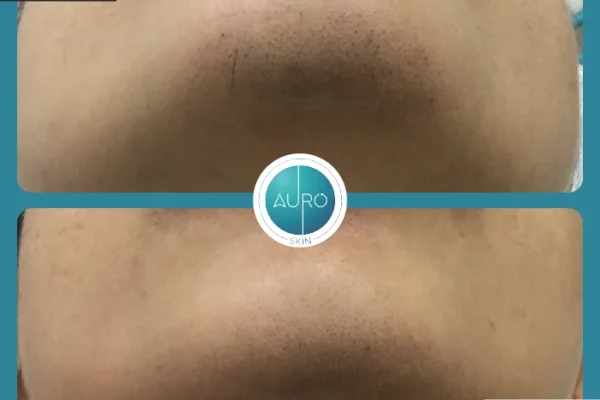 8. hair reduction treatment