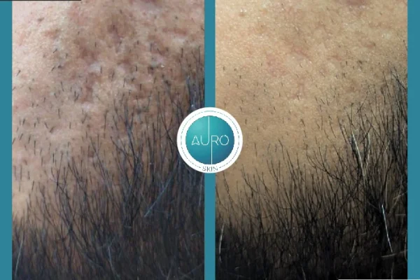 Acne scares treatment at auro skin clinic