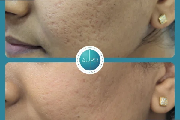 Acne scars treatment result