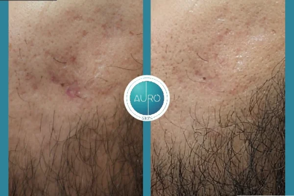 before and after result for acne scares treatment