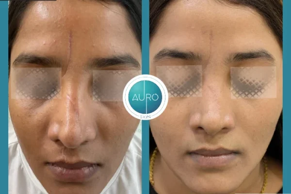 dermapen microneedling benefits