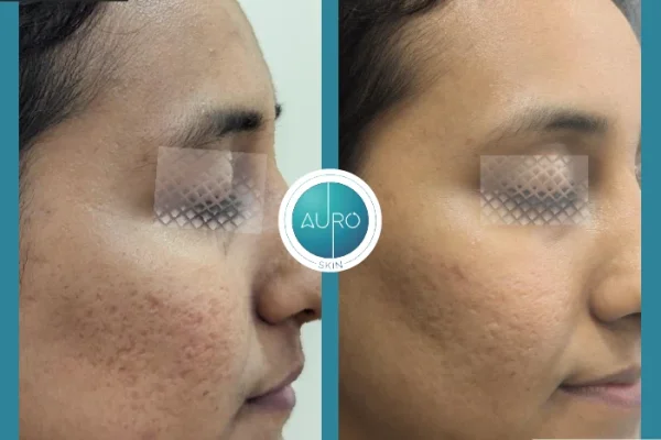 dermapen microneedling cost