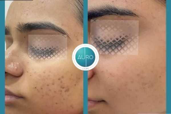 dermapen microneedling in Mumbai