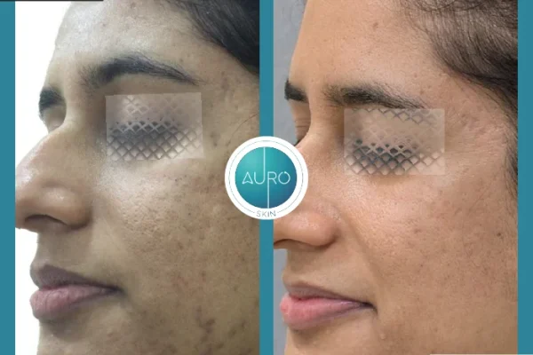 dermapen microneedling treatment