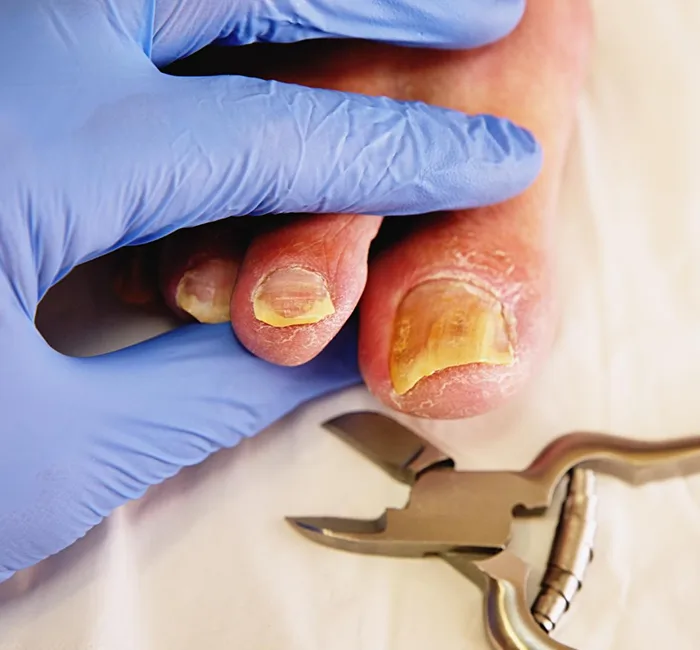 nail disease treatment