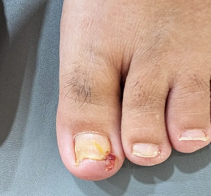 nail fungus