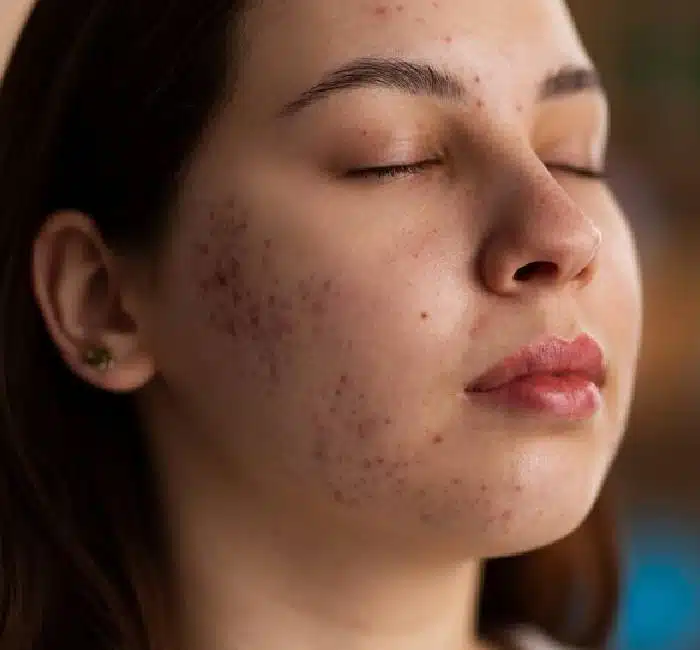 Skin Treatment in Mumbai